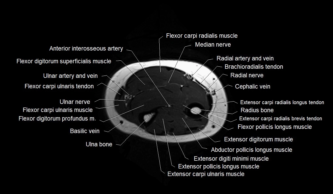 MRI 3T forearm axial cross sectional anatomy image 32.webp